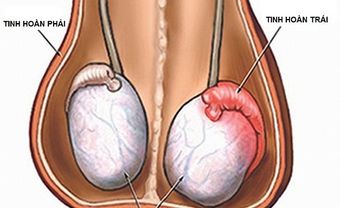 Viêm tinh hoàn: Nguyên nhân, dấu hiệu và cách điều trị - Blog Marry