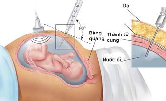 Các mốc thời gian tiến hành sàng lọc trước sinh - Blog Marry